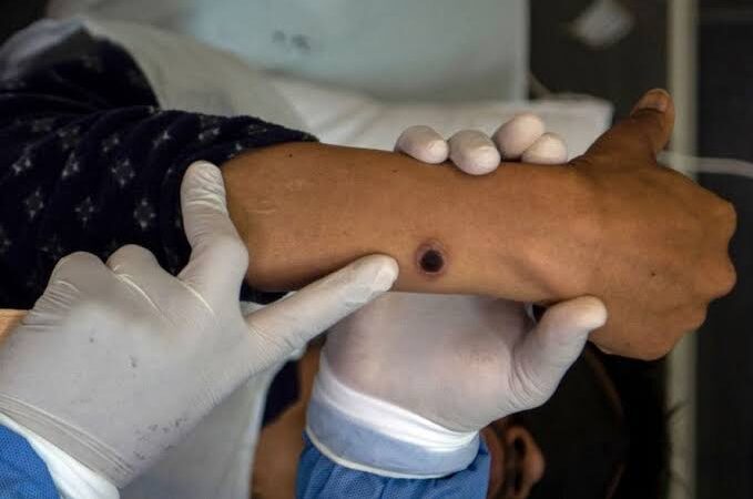 Espírito Santo Registra Oito Casos de Mpox em 2024